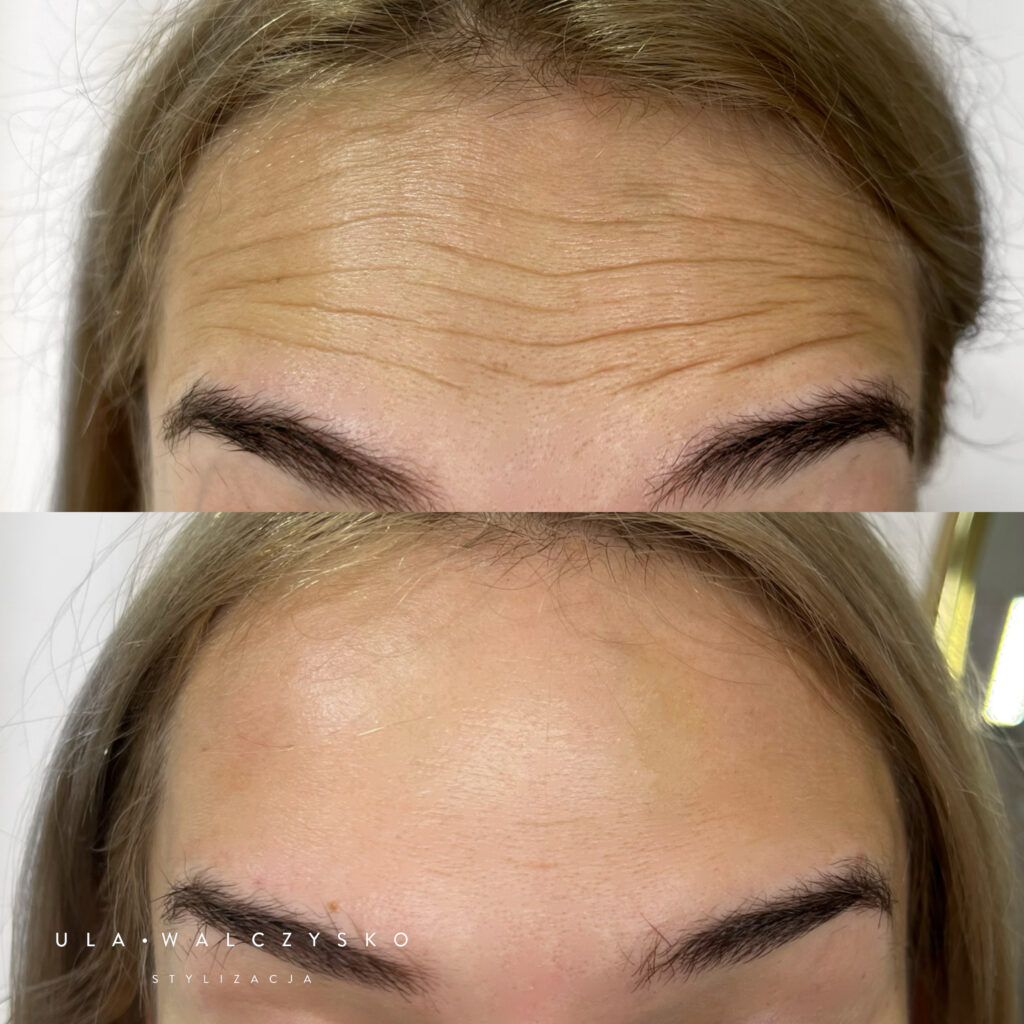 botox czoło ustroń