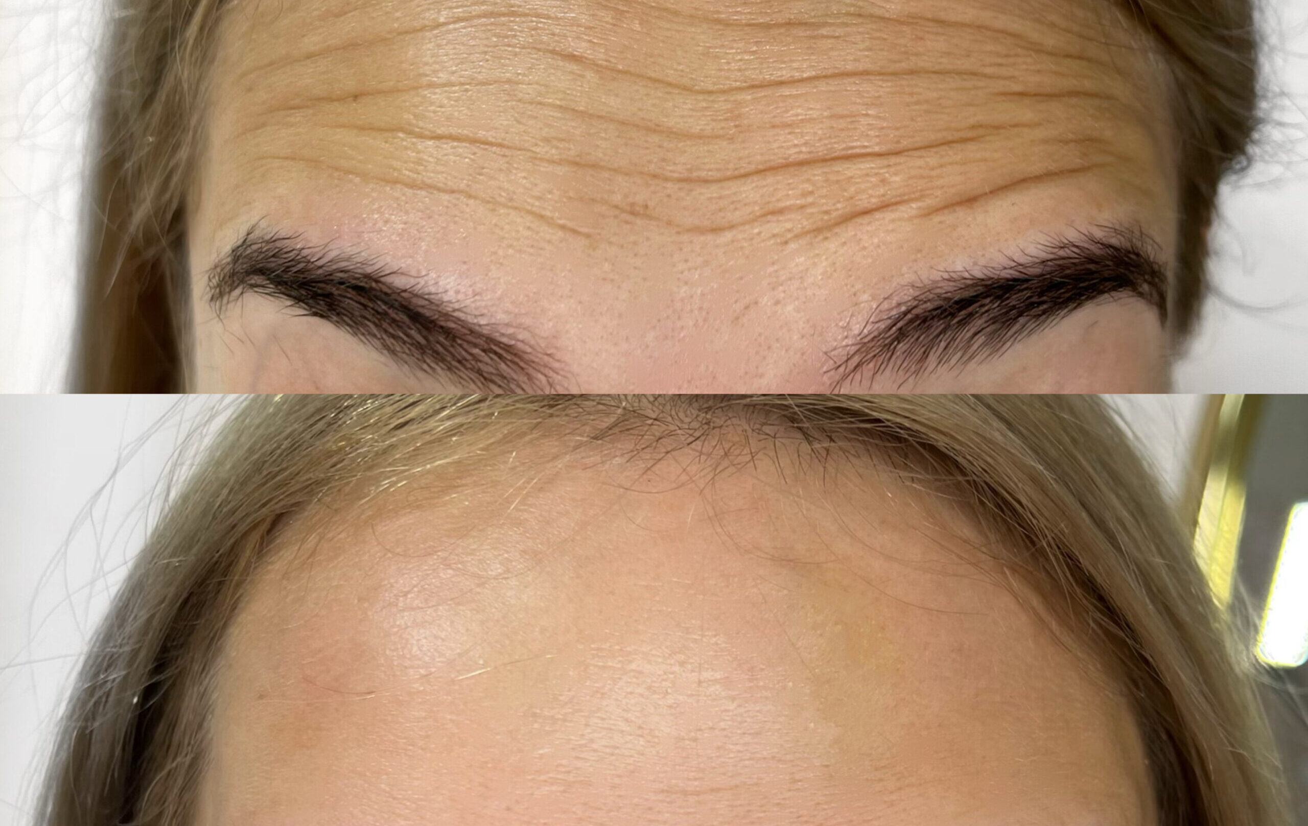 botox czoło ustroń