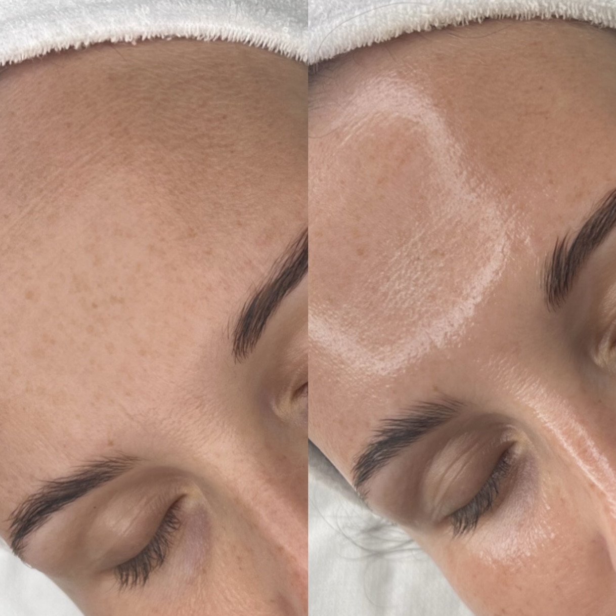 glass skin zabieg na twarz