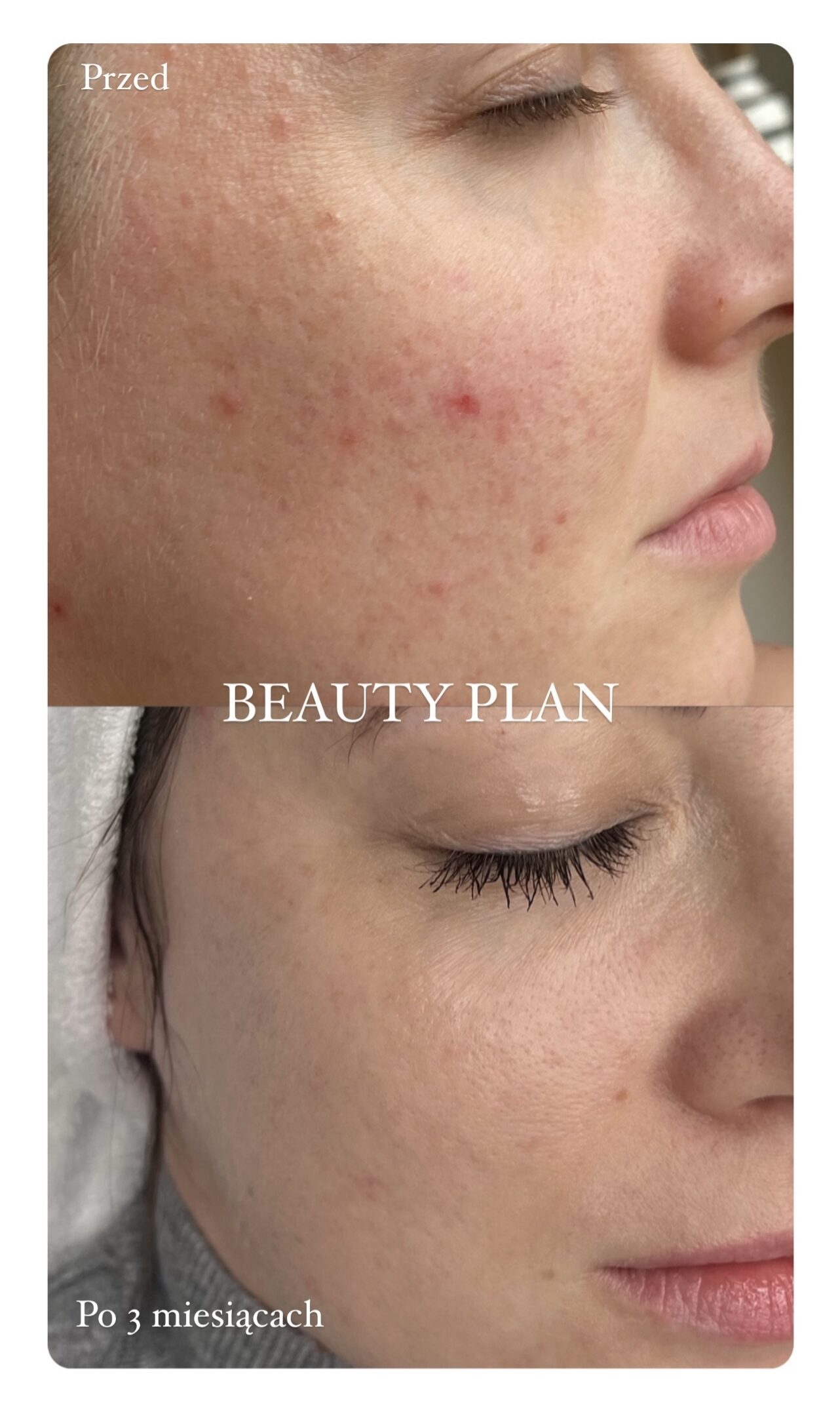 PLAN PIELĘGNACJI PRZED PO