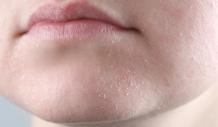 sucha skóra w praktyce